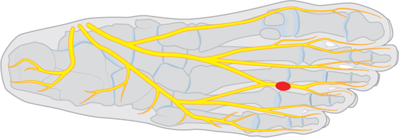 Neuroom van morton: verdikking van de gevoelszenuw van de tenen.